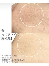 【Q＆A】背中改善がしたいのですが、背中ハーブピーリングか背中フォトどちらがいいですか？