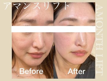 ミリュール(Millule)/アマンス施術前と施術1週間後