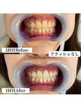 ラペカ(Lapeca)/セルフホワイトニング名古屋