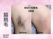 アルゴ 山口宇部店(ALGO)/即日！脇脱毛+WAX