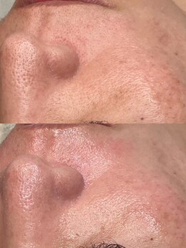 アズール 春日井店(AZURE)の写真/毛穴・ニキビ・トラブル肌はもう怖くない！ララピール・ポテンツァで自信あふれるツヤ肌へ◎