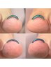 フット【巻き爪ケア】食い込み・見た目でお困りの方に/痛く無い施術方法