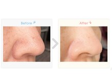 アンス(Ance)/イチゴ鼻/小鼻の黒ずみ改善!1回!