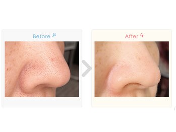 アンス(Ance)/イチゴ鼻/小鼻の黒ずみ改善!1回!