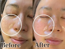 いやしの家さくら/シミケアビフォーアフター