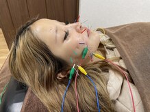 キャンディ鍼灸整骨院の雰囲気（40本以上の鍼をお顔に刺し全てに電気を流しリフトアップ☆彡）