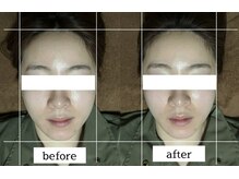 ダイアリー(DIARY)/小顔矯正