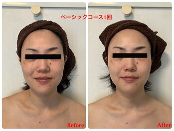 アイリス(AIRIS)/左右差にお悩みの方