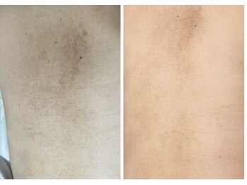 ラビエス(LAVIES)/【40代】背中ニキビにアプローチ