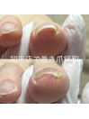 ご来店当日から巻き爪が緩和