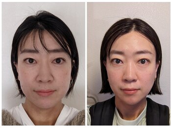 ビュート/一年半の小顔ケアで輪郭激変