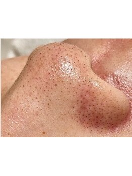 毛穴ケアをしたい