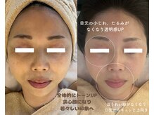 何をしても変わらなかった方。幹細胞エクソソームで素肌力UP！