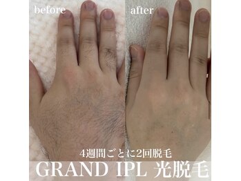 コアラッシュ(COA LASH)/手の甲、指脱毛