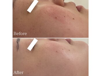 ミエル 神戸店(Miel)/肌質改善トリートメント