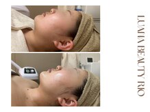 リオ(RIO)/【初回】劇的リフトアップ★