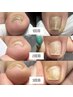foot【巻き爪補正親指2本】+ワンカラー！