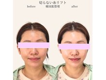 エテルナ バイ ハクビ(Eterna byHAKUBI)の雰囲気(new☆切らない糸リフト♪1回でも美白、ハリ、ツヤ、小顔に!)