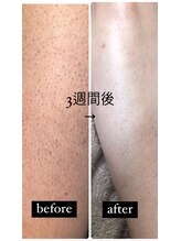 ツリービューティー(Tree Beauty)/before after