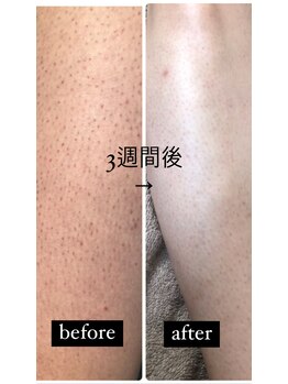 ツリービューティー(Tree Beauty)/before after