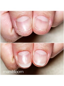 マニブルーム/深爪矯正/長さ出し
