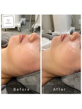 サロン ド パーフェクション(Salon de Perfection)/小顔リフト