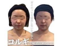 小顔フェイスラボ 名駅店(小顔 Face Labo.)の雰囲気（たった2か月で、痩せた？って言われるくらいの変化を実感♪）