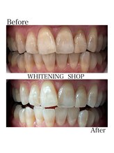 ホワイトニングショップ 倉敷店/【倉敷】セルフホワイトニング