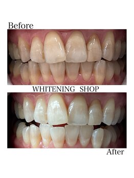 ホワイトニングショップ 倉敷店/【倉敷】セルフホワイトニング