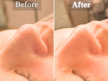 ボーンオム(Born Homme)/毛穴洗浄＋美容液導入：20代女性