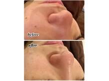 大人気！ハイドロ毛穴洗浄&高純度エクソソーム導入で艶ピカ肌☆