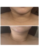 ポマイカイ 名古屋丸の内店(pomaikai)/首肩リンパケア