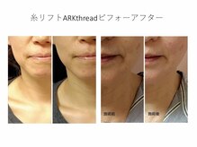 ルミナスパリジェンヌ 甲府店の雰囲気（バチ上げフェイスライン！！アゴスッキリ！ほうれい線！糸リフト）
