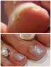《Foot》巻き爪改善ケア ワンカラー 【フットバスケア付き】¥13000