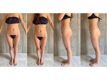 ブランカ(BLANCA)/インディバ/美脚・美尻/痩身