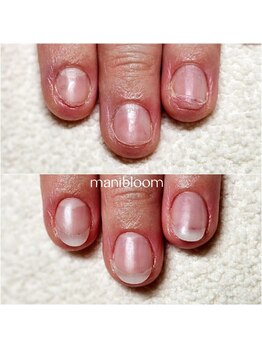 マニブルーム/深爪矯正/長さ出し