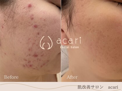 アカリ(acari)の写真