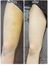 インディバジェム(GEM)/ビフォーアフター