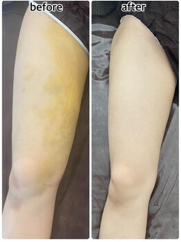 インディバジェム(GEM)/ビフォーアフター