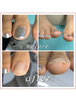 巻き爪補正店 大阪なんば店/ネイルオフ