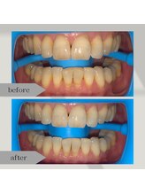 ムーンホワイトニング(Moonホワイトニング)/【美容】1回 施術例