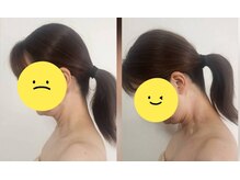 スマイリー(smiley)/可動域が改善