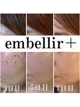 アンベリールプラス(embellir+)/理想の毛穴レスへ