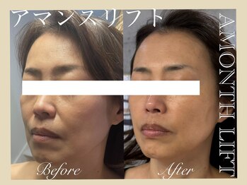 ミリュール(Millule)/4回の施術後