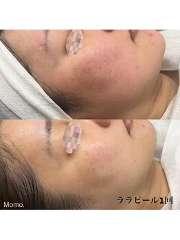 モモ(Momo.)/ララピール【ほうれい線/乾燥】