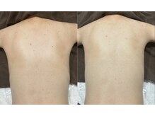 チャマ 高知店(CHAMA)/背中フォトで美肌に！