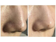 リメレ(Rimere)/毛穴洗浄