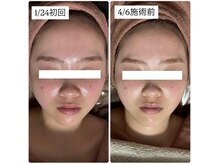 アルムダアクア 天王寺店(Aleumda AQUA)/ハーブピーリング/大阪/天王寺