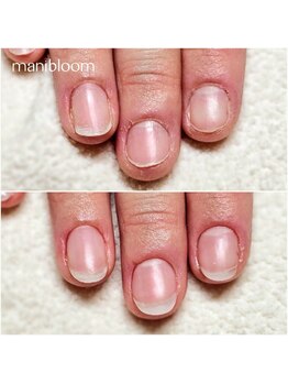 マニブルーム/深爪矯正/長さ出し