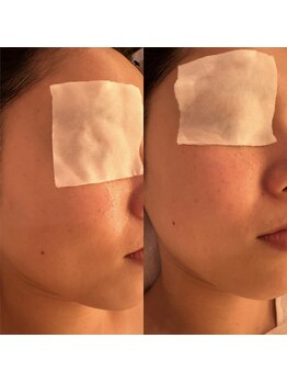 凪 横浜/光フェイシャル